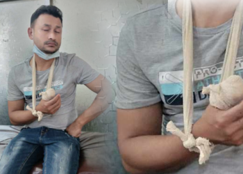 কাঁচপুরে বড় ভাইয়ের দাতের কামড়ে ছোট ভাইয়ের বৃদ্ধা আঙুল বিচ্ছিন্ন