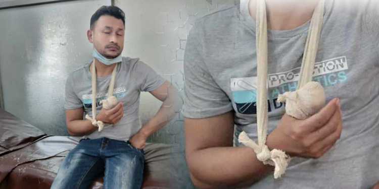 কাঁচপুরে বড় ভাইয়ের দাতের কামড়ে ছোট ভাইয়ের বৃদ্ধা আঙুল বিচ্ছিন্ন